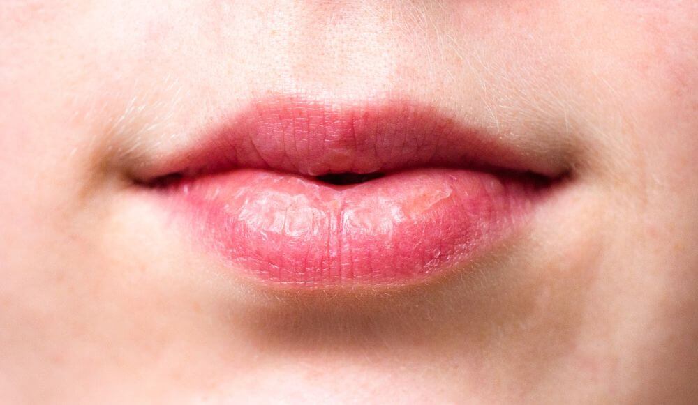 Jakie powikłania są możliwe po zabiegu powiększania ust?